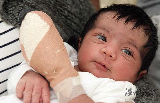 護士剪臍帶誤剪嬰兒手指女嬰被緊急送醫接斷指