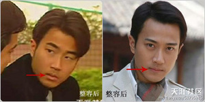 整容部位六:下顎(磨腮)