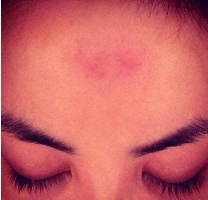 王菲西藏朝圣磕頭磕到額頭紅腫