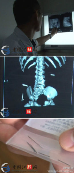 女嬰體內4根繡花針