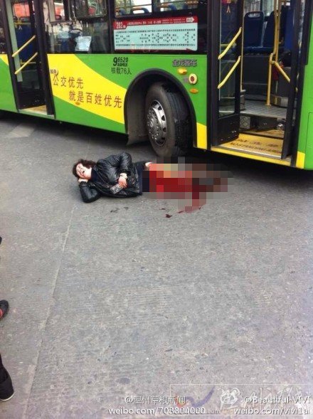 女子被公交車碾斷腿