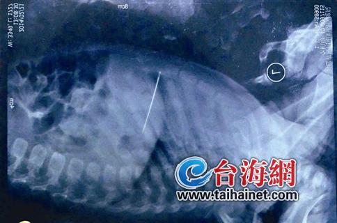 5厘米長的繡花針扎入體內(nèi) 1歲嬰兒被針扎入胸腔