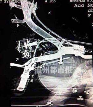 樂清小女孩頭部扎進螺絲帽 電瓶車頭螺絲帽插進后腦