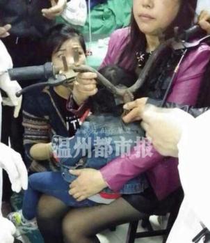 樂清小女孩頭部扎進螺絲帽 電瓶車頭螺絲帽插進后腦