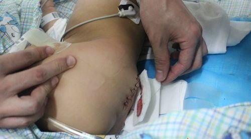 湖南尾巴男嬰手術很成功 不切除小尾巴可致癱瘓