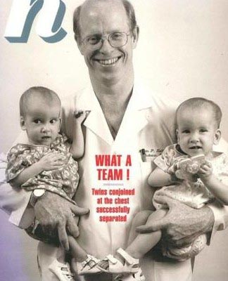 連體嬰姐妹分離變美女