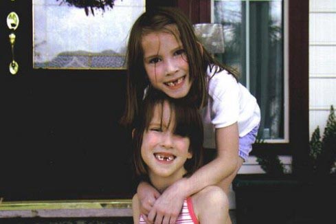 連體嬰姐妹分離變美女