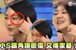 小s疑遭到家暴眼角有傷 微博秀恩愛破傳聞