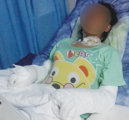 手持氫氣球爆炸燒成造成20%燒傷，溫州女子被氫氣球炸傷