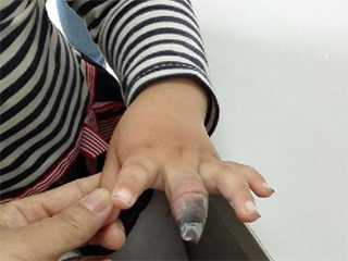 4歲女童創(chuàng)可貼使用不當截肢