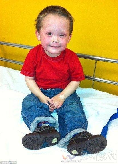 英國男孩摩根出生4個月開始過敏