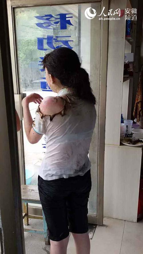 女生被潑酒精燒傷