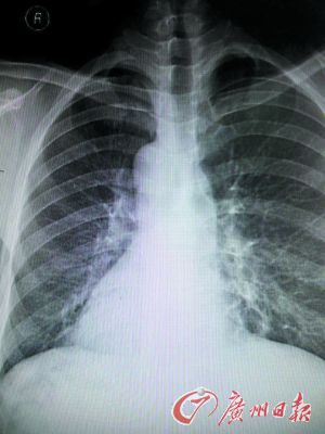 X光片上袁先生的心臟陰影在右邊。