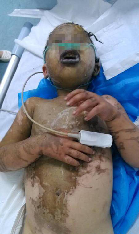 兄妹被人強灌硫酸