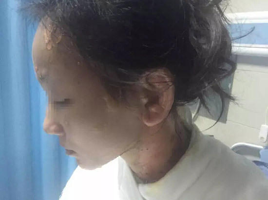 女子遭服務員潑熱湯