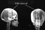 腦里藏針46年 安徽淮北48歲女子腦袋里藏有1枚針起碼