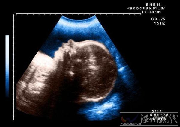 埃及嬰兒一只眼睛