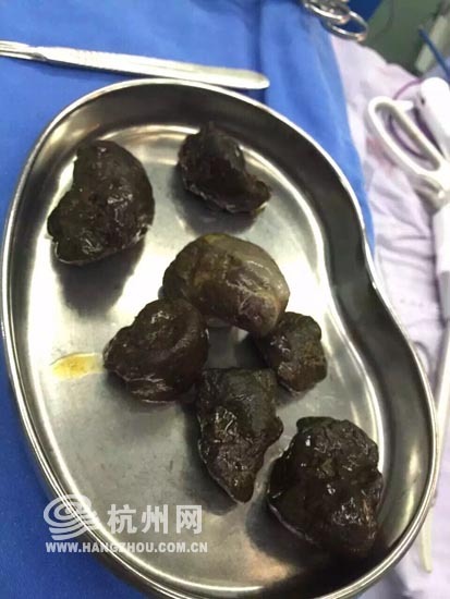 吃柿子導致胃結石