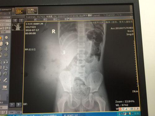 8歲男孩被人用充氣泵往肛門充氣 腸子差點被吹爆