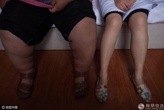 16歲女孩重330斤