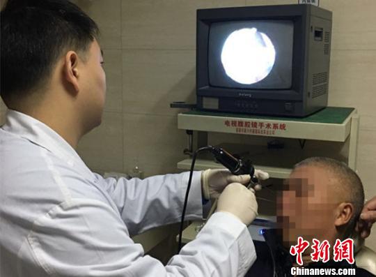 鼻腔取出5cm螞蝗