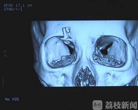 女孩牙齒飛入眼眶