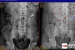 男子長U形馬蹄腎 反復生腎結石