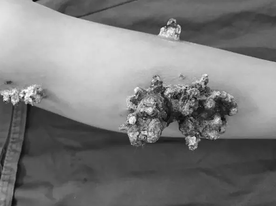 男孩身上長珊瑚