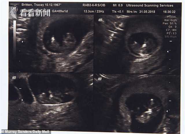 51歲祖母生4胞胎